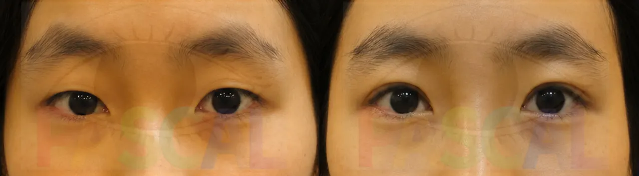 Before and after buried-suture double eyelid surgery (before)