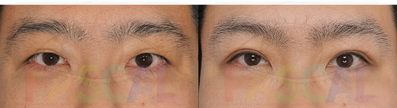 Before and after buried-suture double eyelid surgery on a second patient (before)