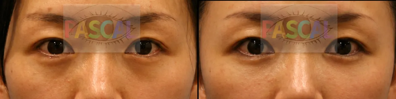Before and after fat grafting for under-eye dark circles (before)