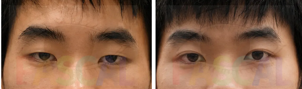 Before and after correction of a high crease with lateral canthal fixation (before)