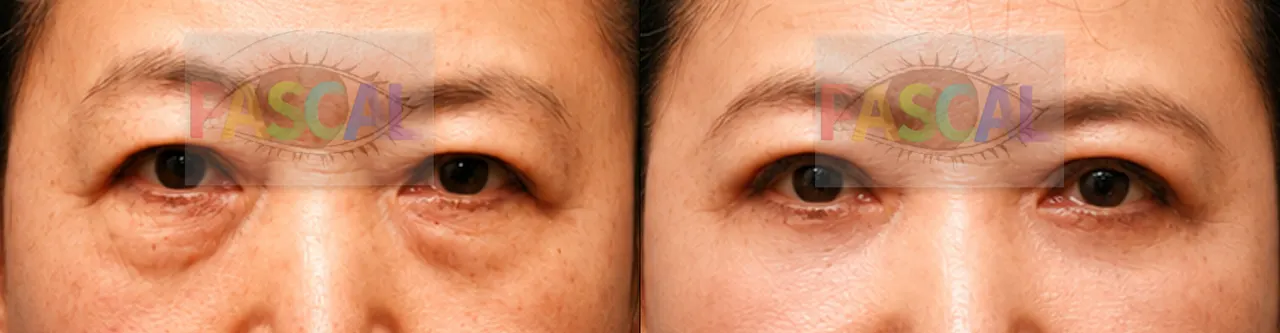 Before and after lower blepharoplasty through the skin (before)