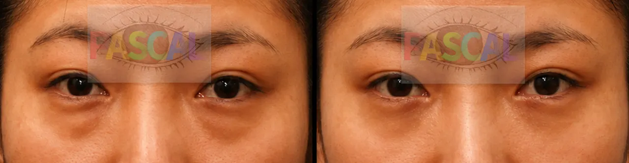 Before and after scarless lower-eyelid fat removal (before)