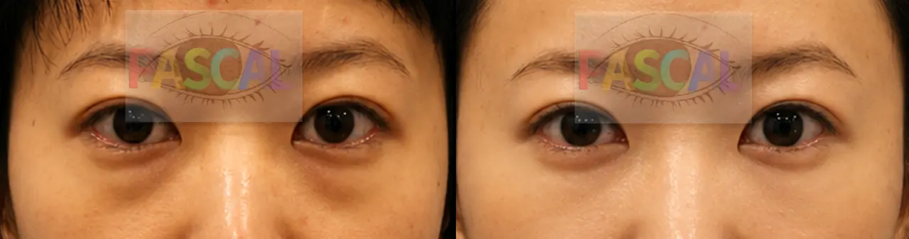 Before and after scarless lower-eyelid fat repositioning (before)