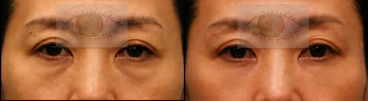 Before and after scarless fat repositioning with fat grafting (before)