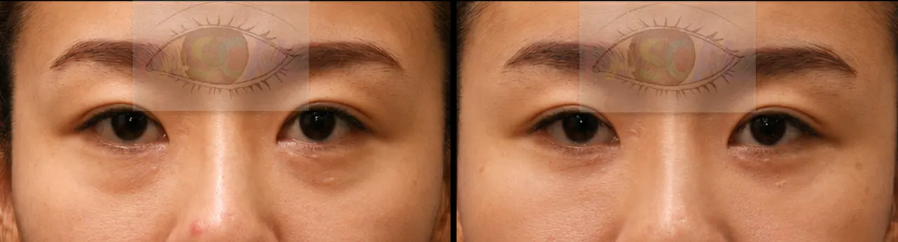 Before and after scarless lower-eyelid fat repositioning, second patient (before)