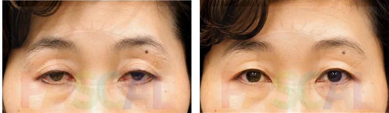 Before and after ptosis correction for a sunken-looking upper eyelid (before)