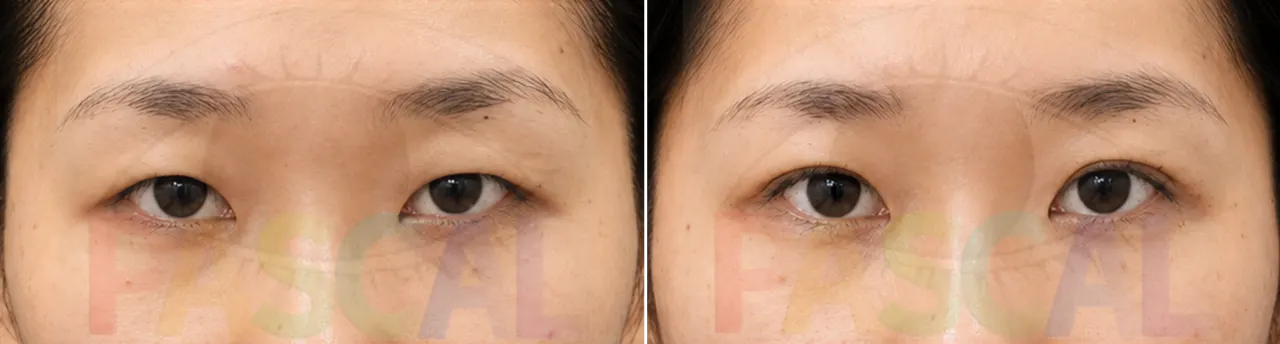 Before and after ptosis correction (before)