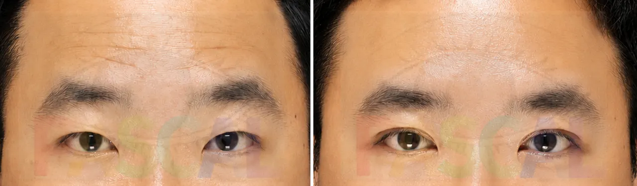 Before and after ptosis correction where forehead lines came from ptosis (before)