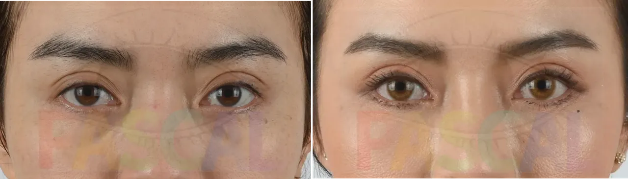 Revision surgery correcting a high crease and lower-lid laxity (before)