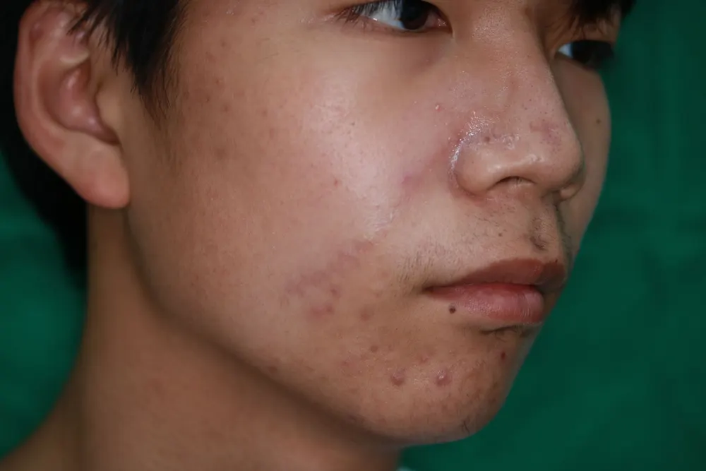 Scar revision on the left cheek, before and 5 months after surgery (after)