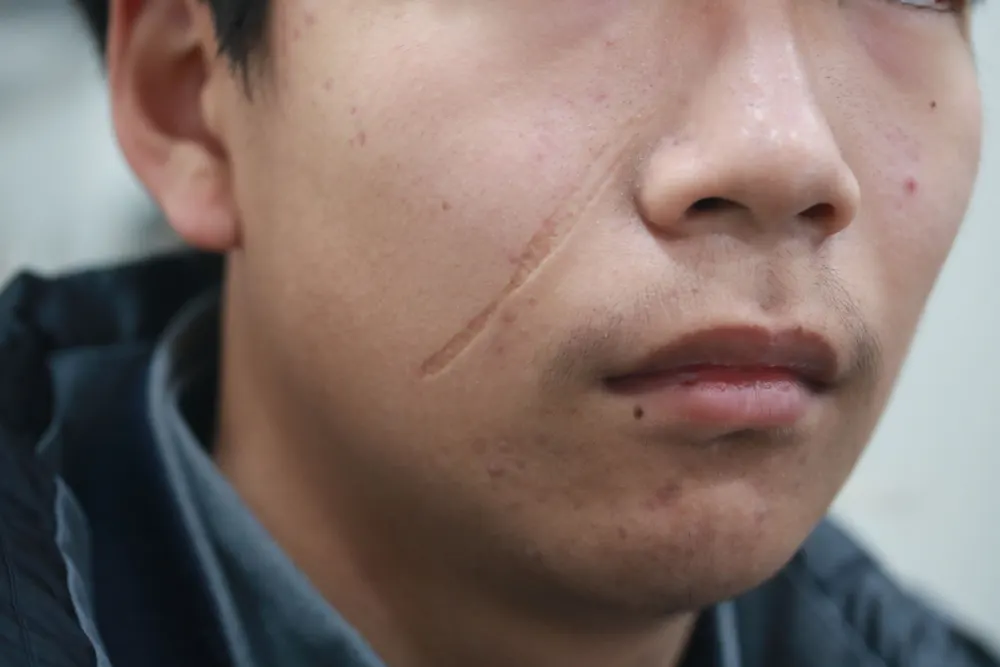 Scar revision on the left cheek, before and 5 months after surgery (before)