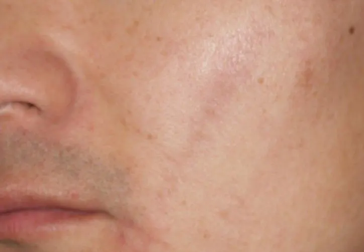 Scar revision on the right cheek, before and 6 months after surgery (after)
