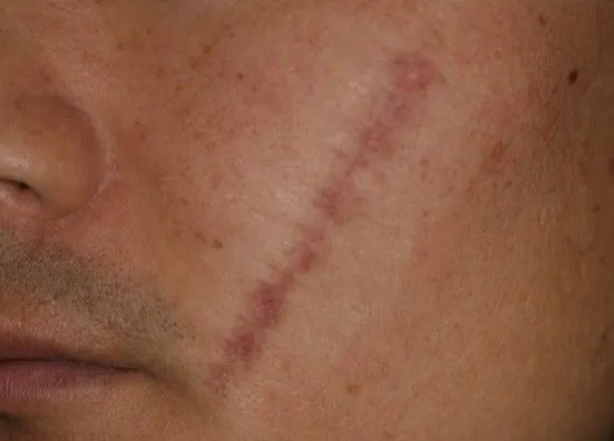 Scar revision on the right cheek, before and 6 months after surgery (before)