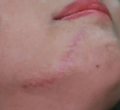 Scar revision on the chin, before and 3 months after surgery (after)