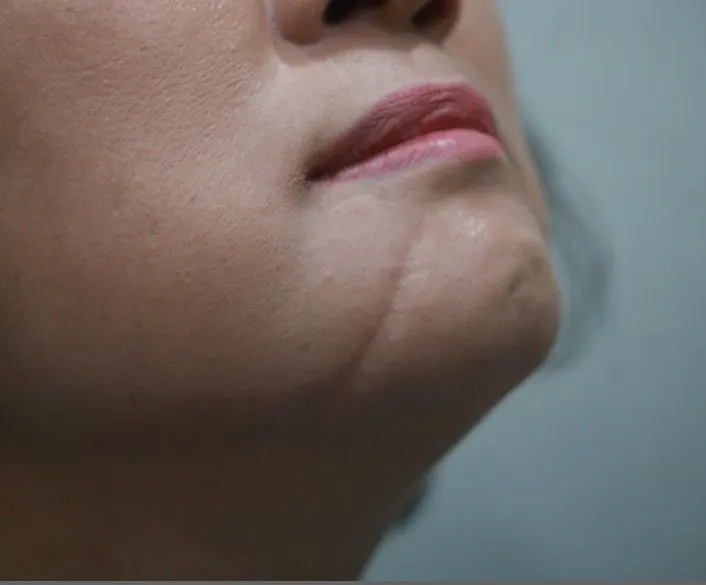 Scar revision on the chin, before and 3 months after surgery (before)