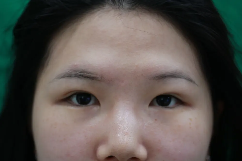 Scar revision on the left eyebrow, before and 7 months after surgery (after)