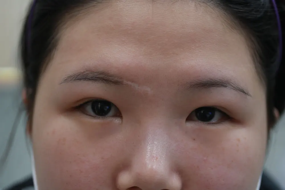 Scar revision on the left eyebrow, before and 7 months after surgery (before)
