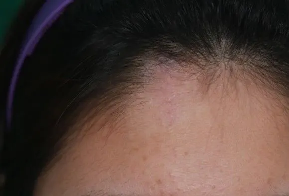 Scar revision on the left forehead, before and 2 months after surgery (after)