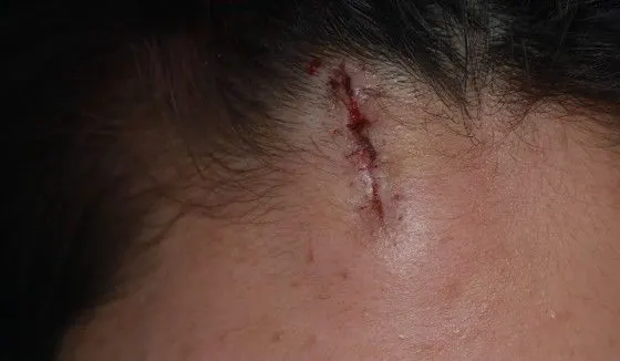 Scar revision on the left forehead, before and 2 months after surgery (before)