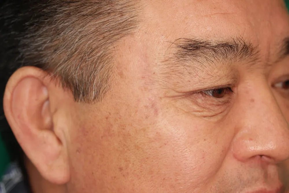 Scar revision on the left temple, before and 3.5 months after surgery (after)