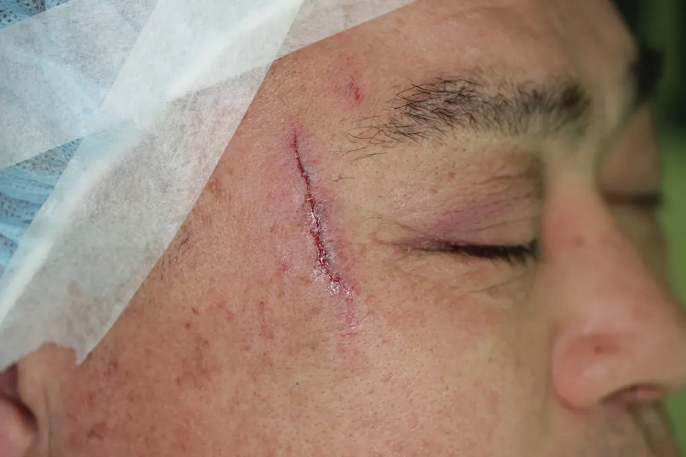 Scar revision on the left temple, before and 3.5 months after surgery (before)